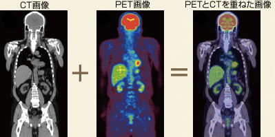 PET検査のメリットのイメージ画像