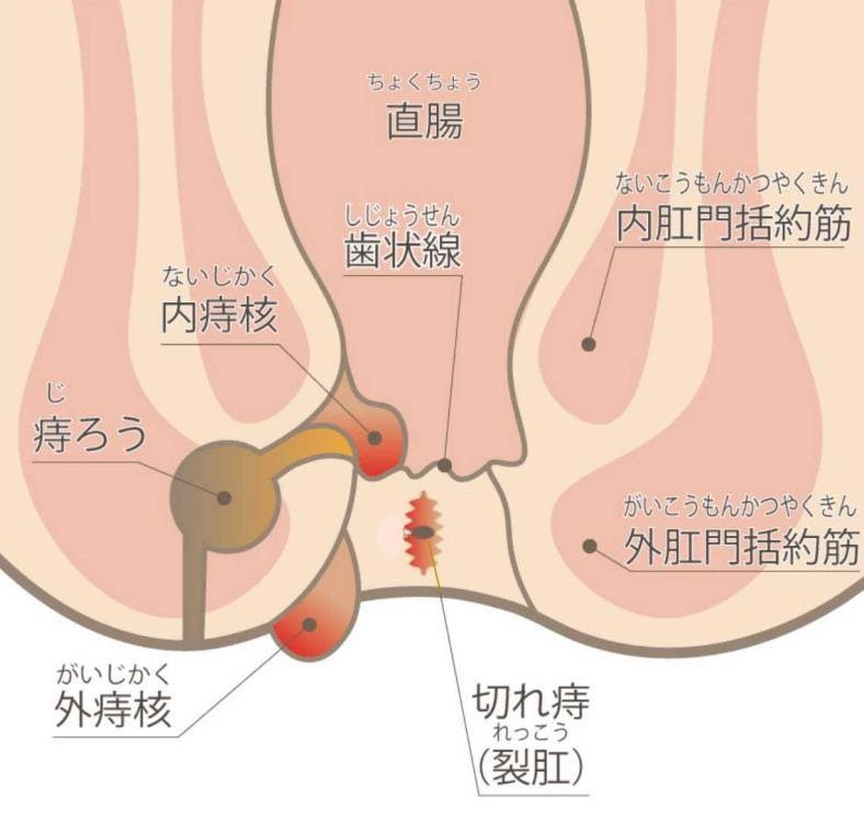 痔核（いぼ痔） ｜たまプラーザ南口胃腸内科クリニック 消化器内視鏡 