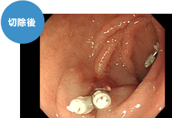 早期十二指腸がん切除後の画像