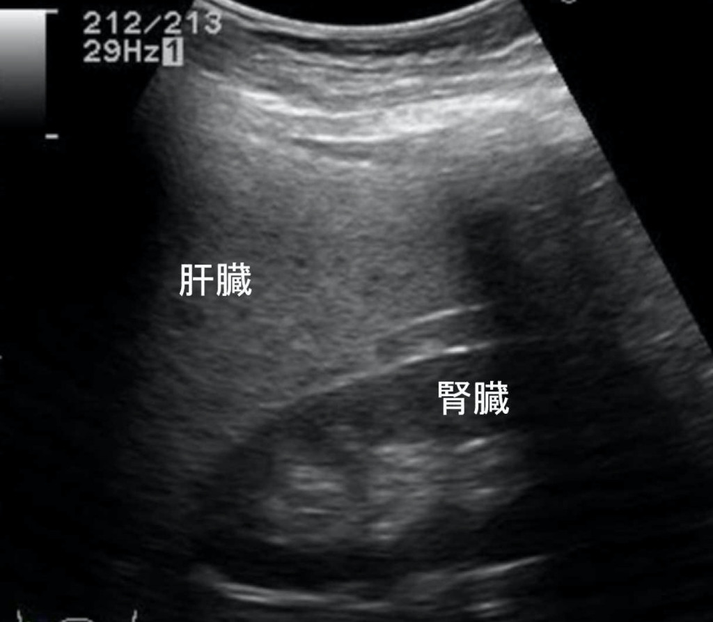 脂肪肝の腹部超音波検査画像