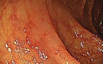 大腸がんになる前に予防できた人、大腸がんになっても早期で発見できた人 ～大腸がんで命を落とさないために～